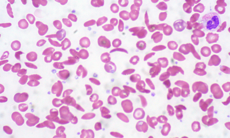 sickle cells 
